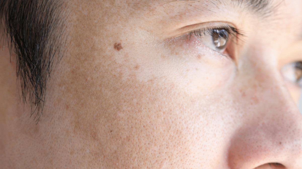 Menghilangkan noda coklat secara alami di rumah