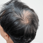 Apakah rambut abu-abu bisa kembali hitam?