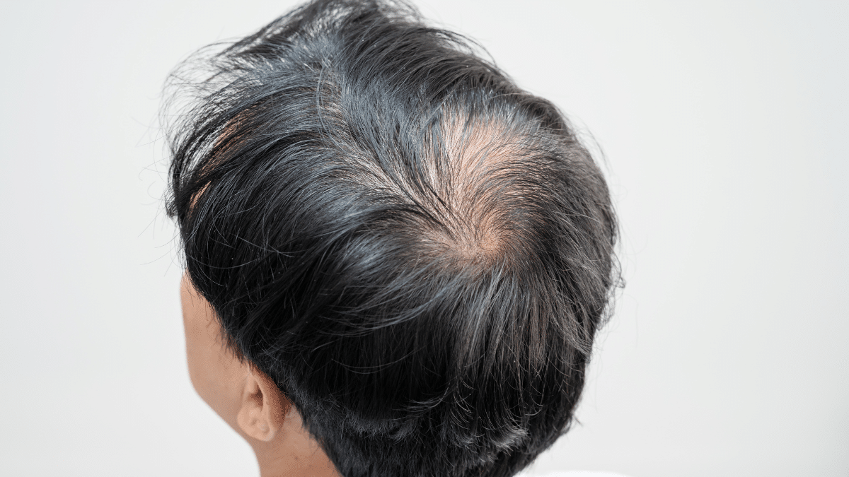 Apakah rambut abu-abu bisa kembali hitam?